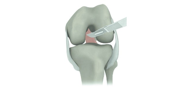 Medially Stabilised Knees in the Literature, Part 2 – Technique